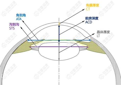 拱高|拱高——ICL晶体手术必须了解的指标‼️